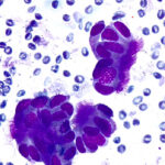 Benign Cells - Diff Quik