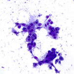 ROSE-Prep: Atypical Cells - Diff Quik