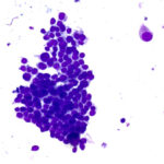 Malignant Cells - Pap Stain