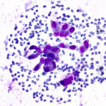 Benign Cells - Diff Quik