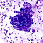 Malignant Cells - Pap Stain
