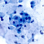 Malignant Cells - Pap Stain