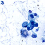 Malignant Cells - Pap Stain