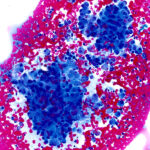 Malignant Cells - Pap Stain