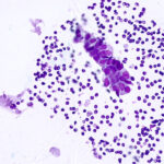 Benign Cells - Diff Quik