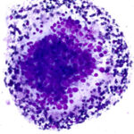 Atypical Cells - Diff Quik