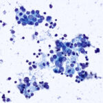 Malignant Cells - Pap Stain