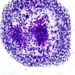 Atypical Cells - Diff Quik