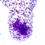 Atypical Cells - Diff Quik